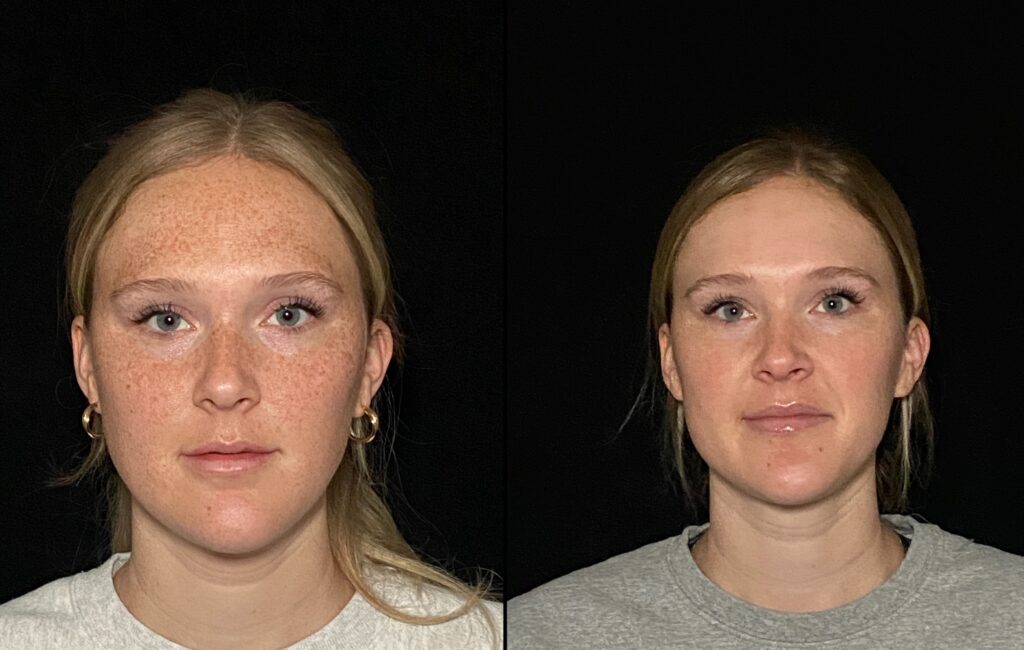 Before and After Image: BBL - front