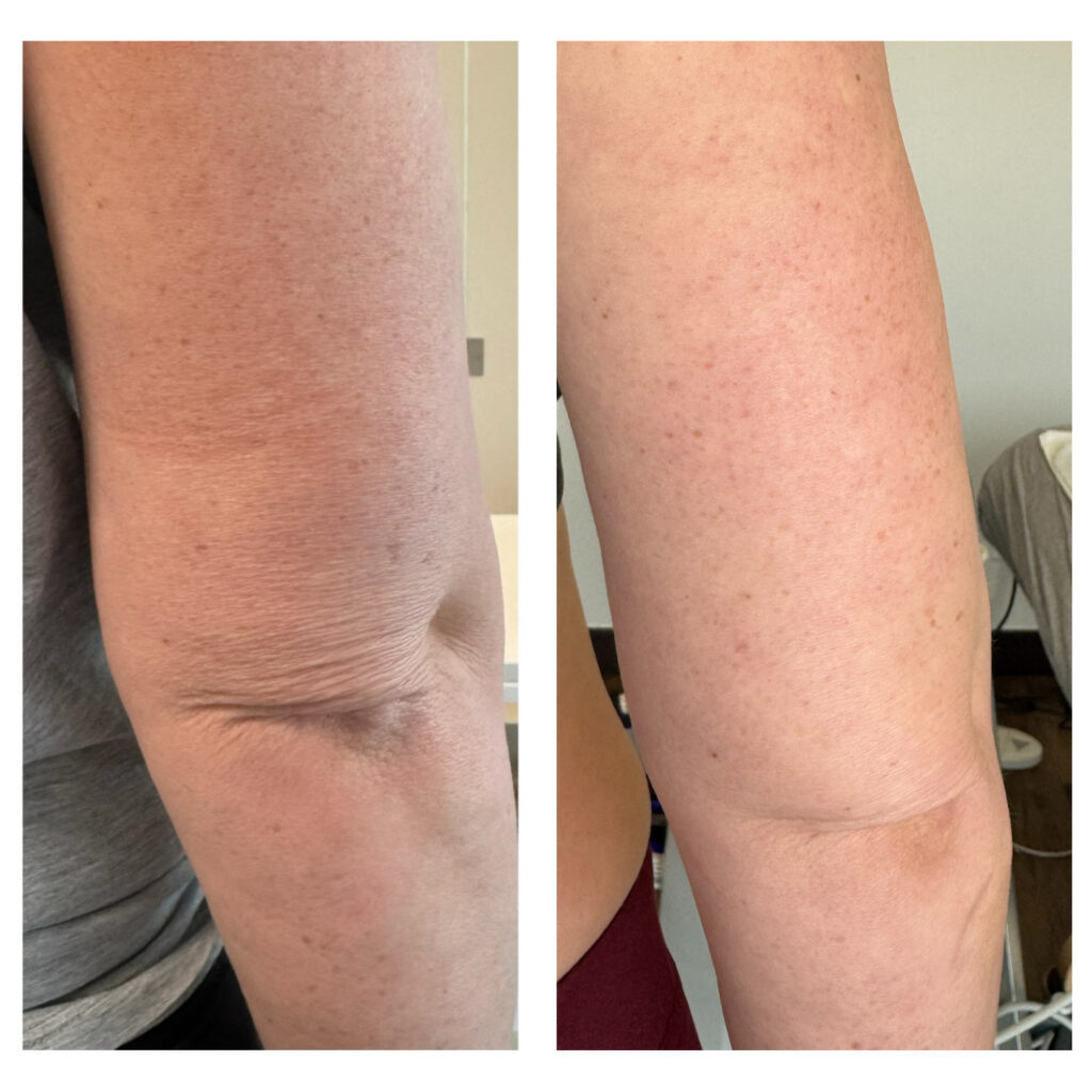 Before and After Image: Exion Ultrasound Arms - back