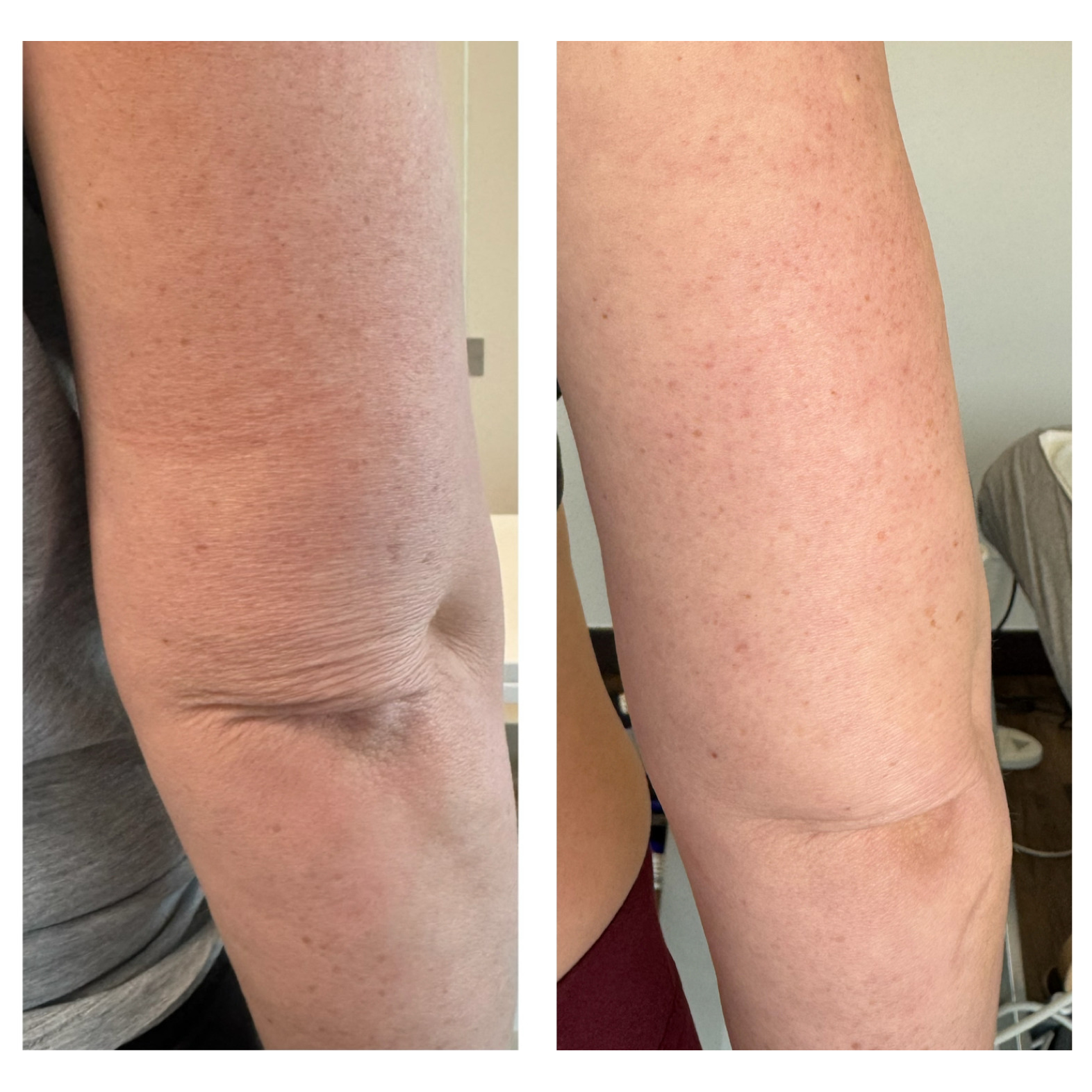 Before and After Image: Exion Ultrasound Arms - back