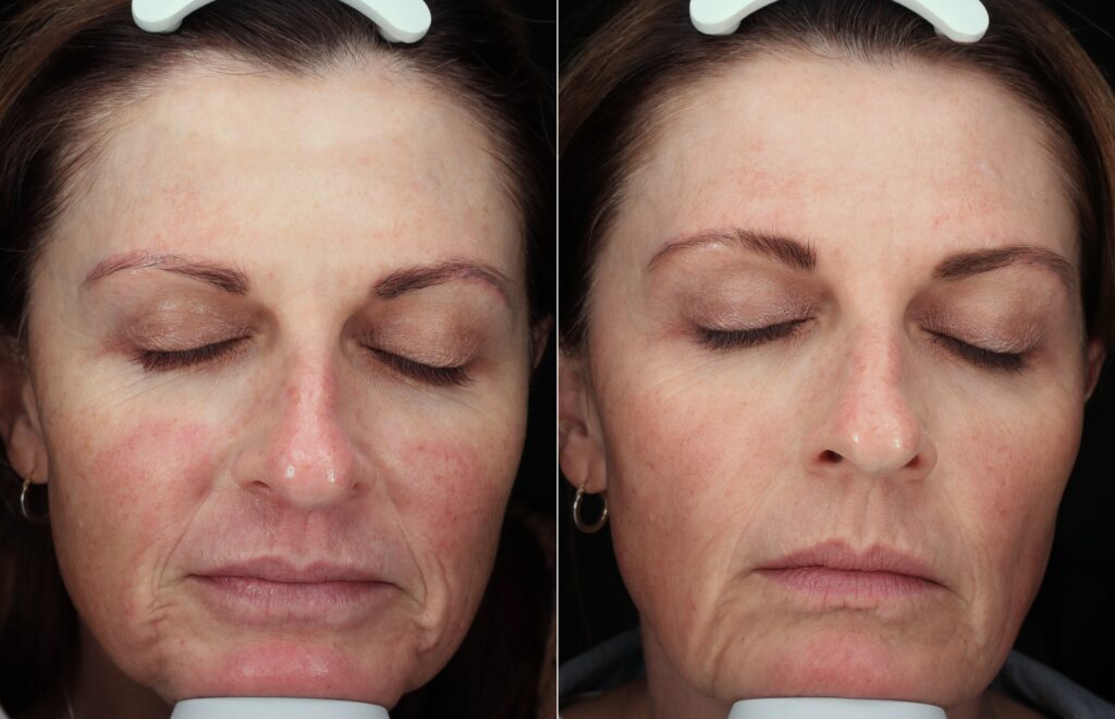 Before and After Image: Exion RF - front