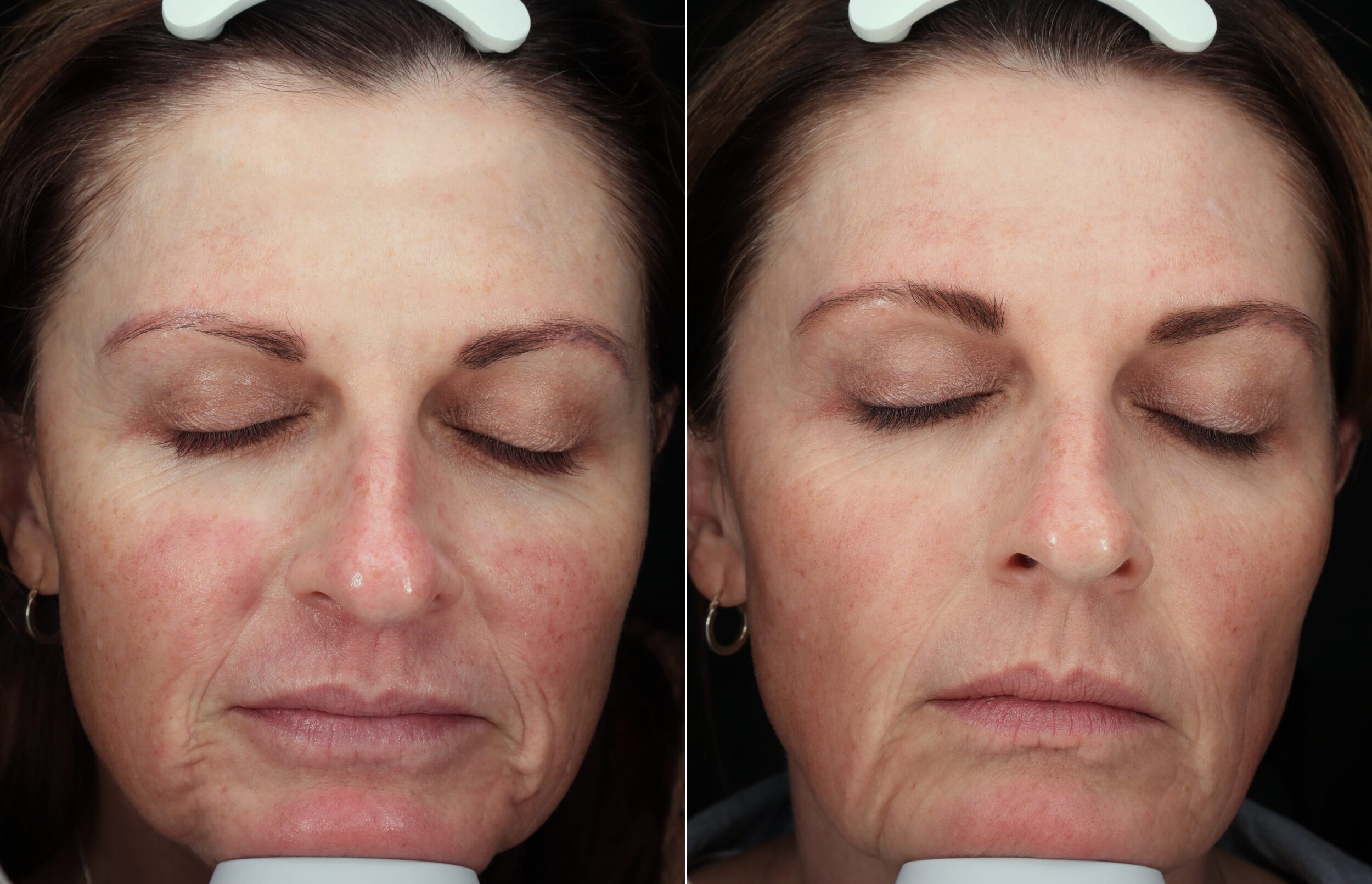 Before and After Image: Exion RF - front