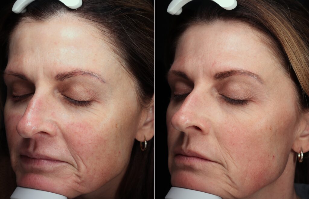 Before and After Image: Exion RF - left-front-oblique