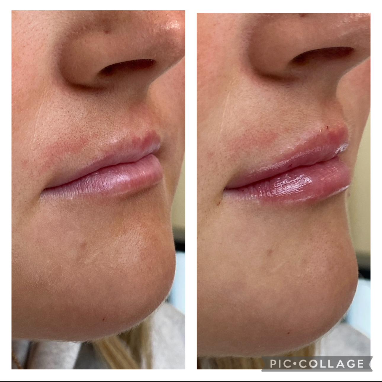 Before and After Image: Filler Kysse - right-front-oblique