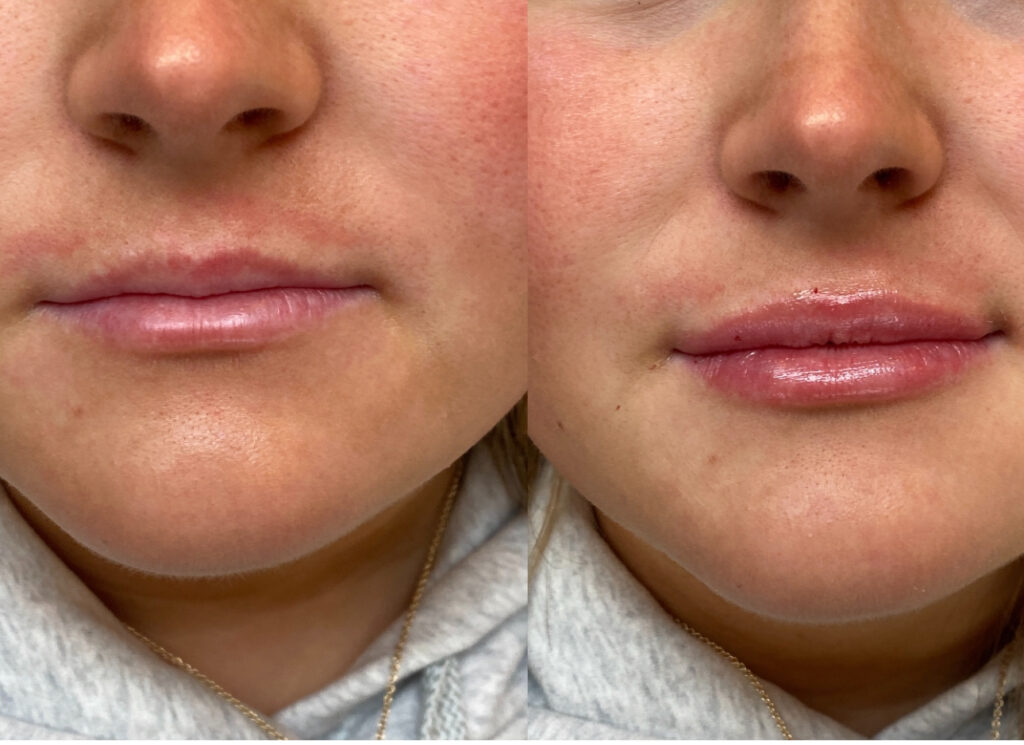 Before and After Image: Filler Kysse - front