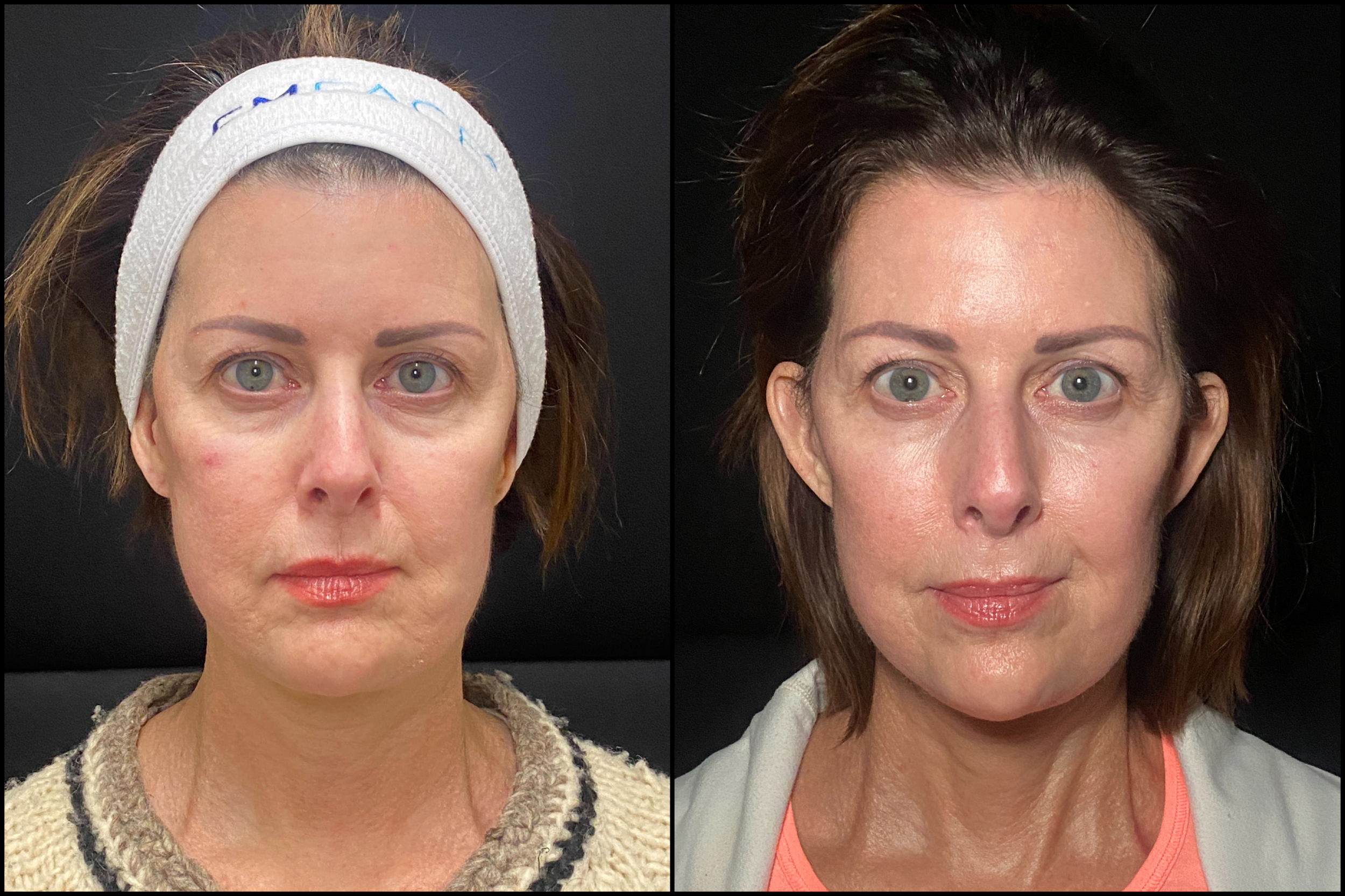 Before and After Image: Emface - front