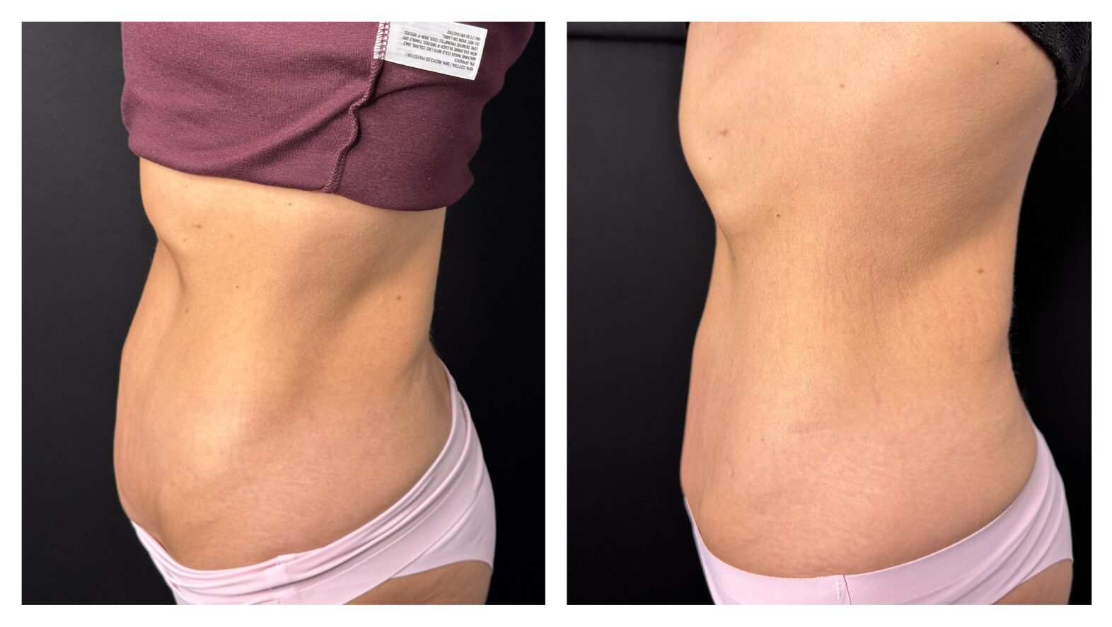 Before and After Image: Exion - left-side