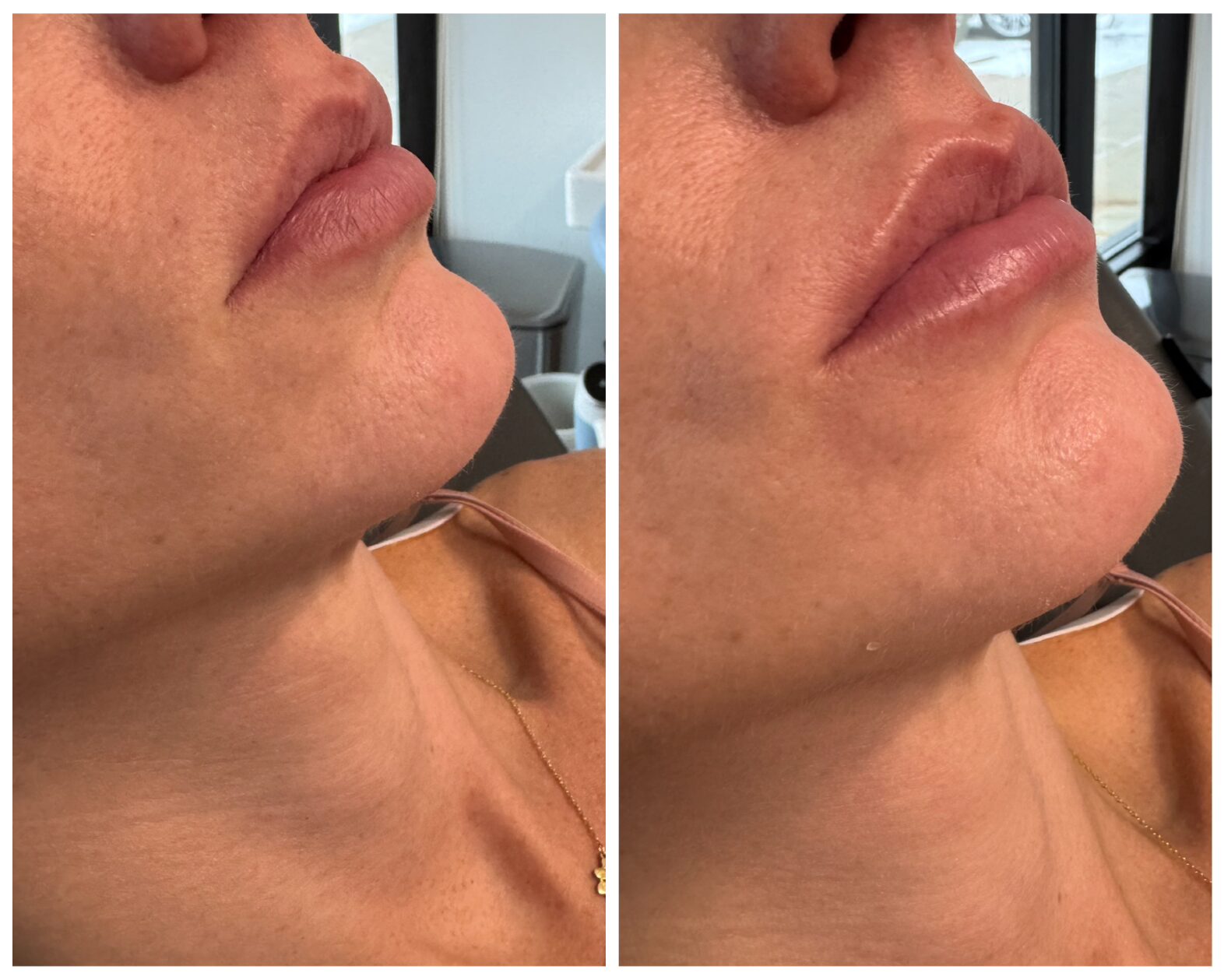 Before and After Image: Exion Ultrasound Lips - right-front-oblique