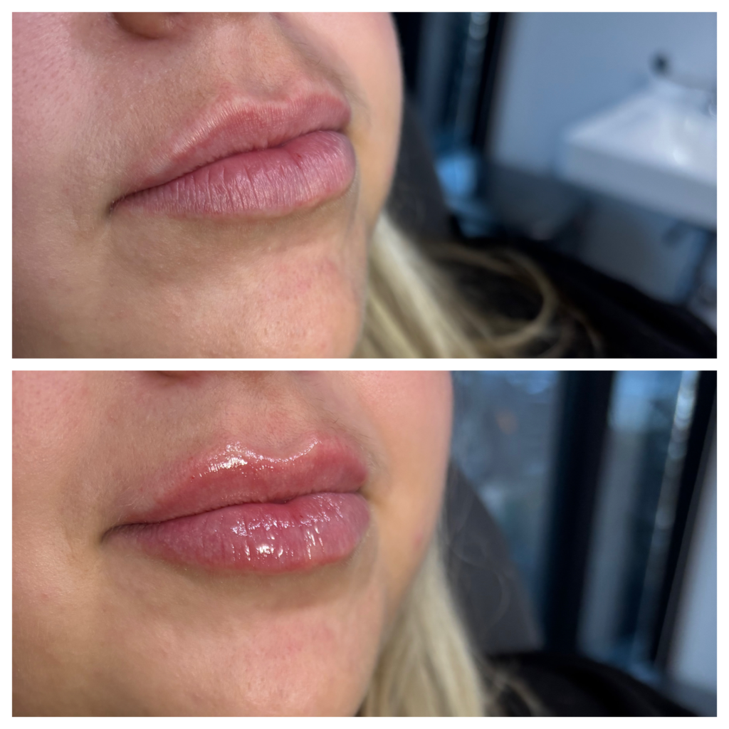 Before and After Image: Lips – Kysse - right-front-oblique