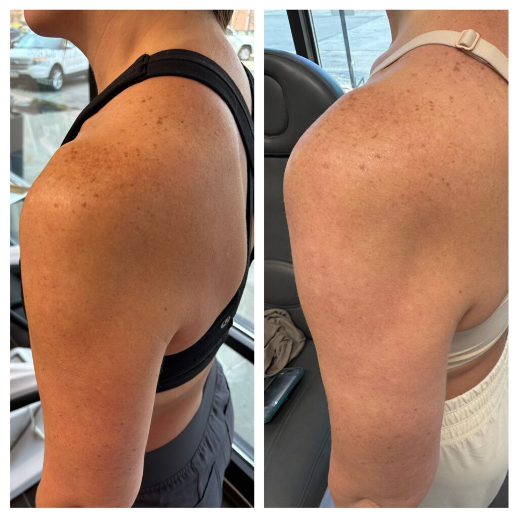 Before and After Image: Moxi - left-side