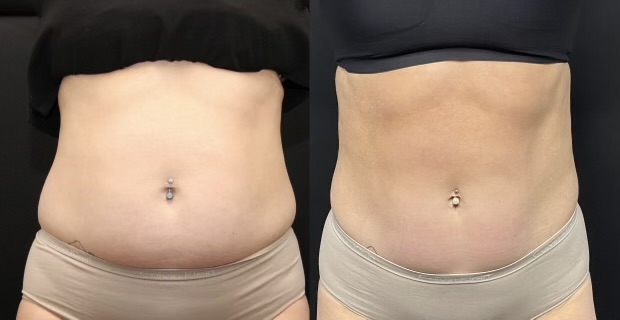 Before and After Image: Emsculpt NEO - front