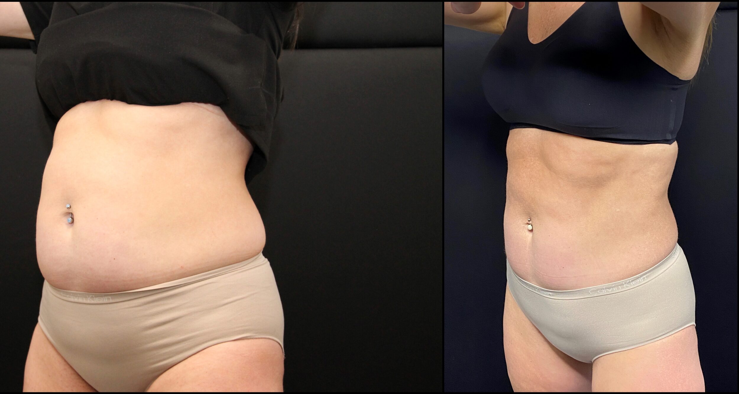 Before and After Image: Emsculpt NEO - left-front-oblique