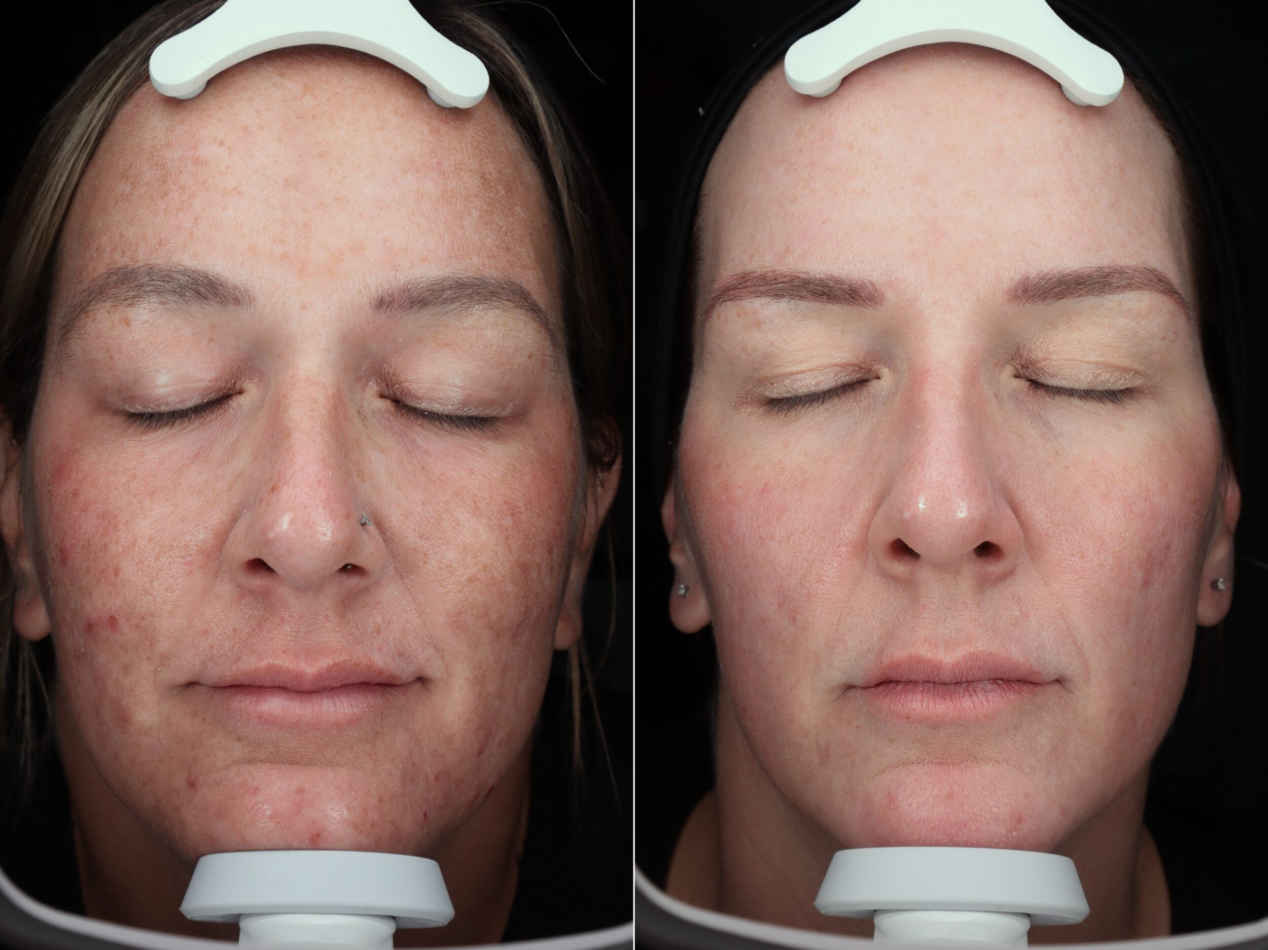 Before and After Image: Visia Scan - front