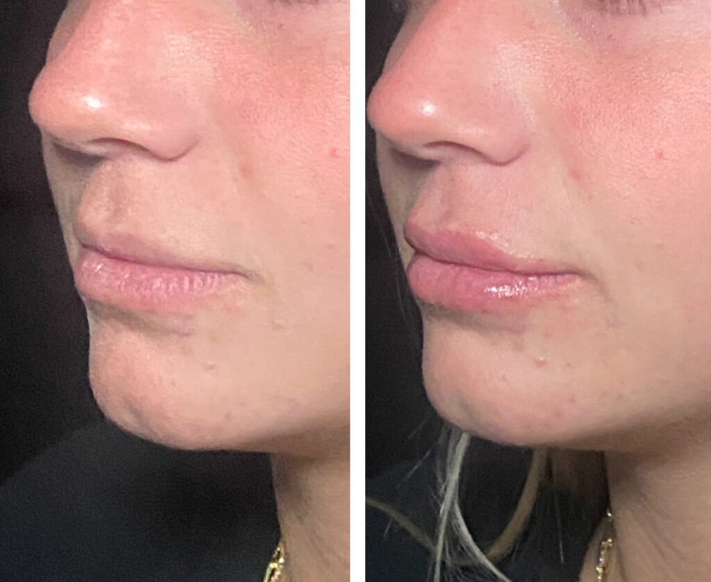 Before and After Image: Lips – Kysse - left-front-oblique