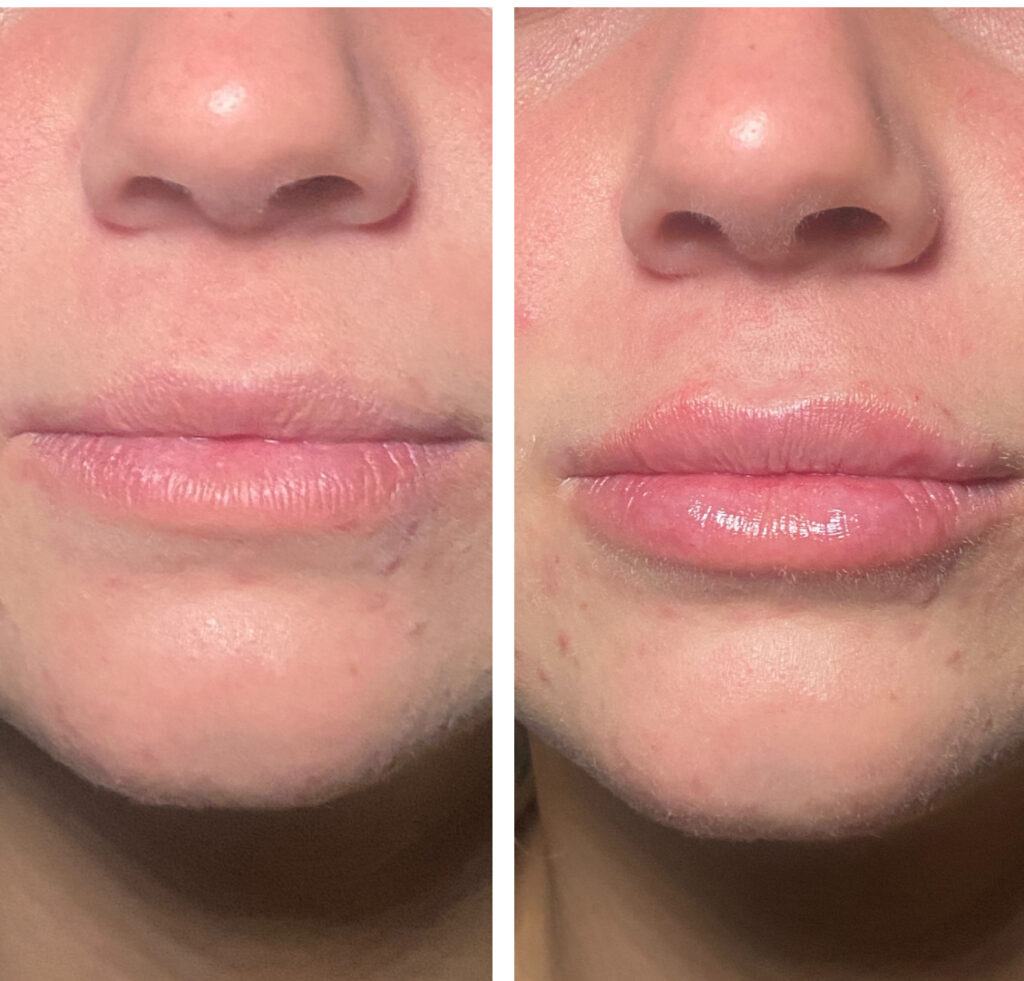 Before and After Image: Lips – Kysse - front