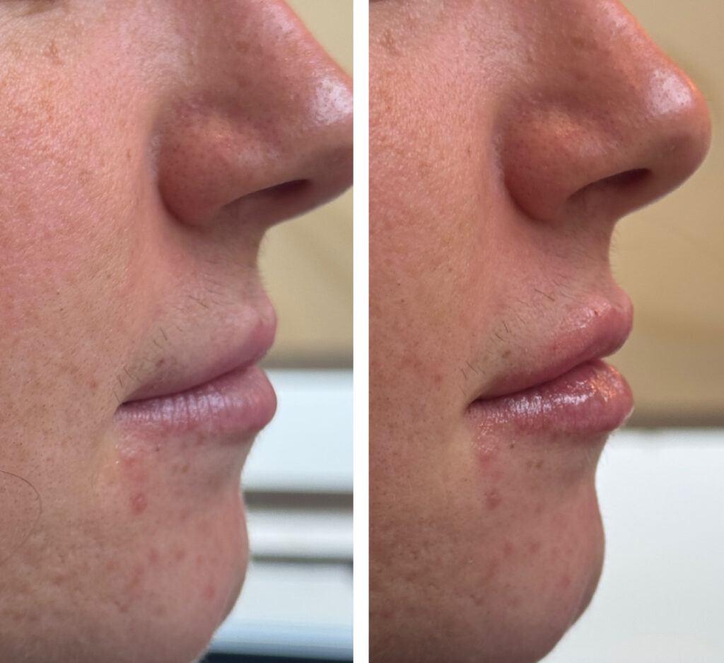 Before and After Image: Lips – Kysse - right-side