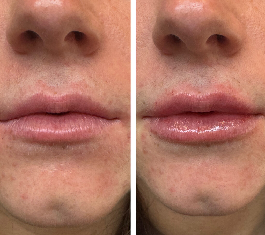 Before and After Image: Lips – Kysse - front