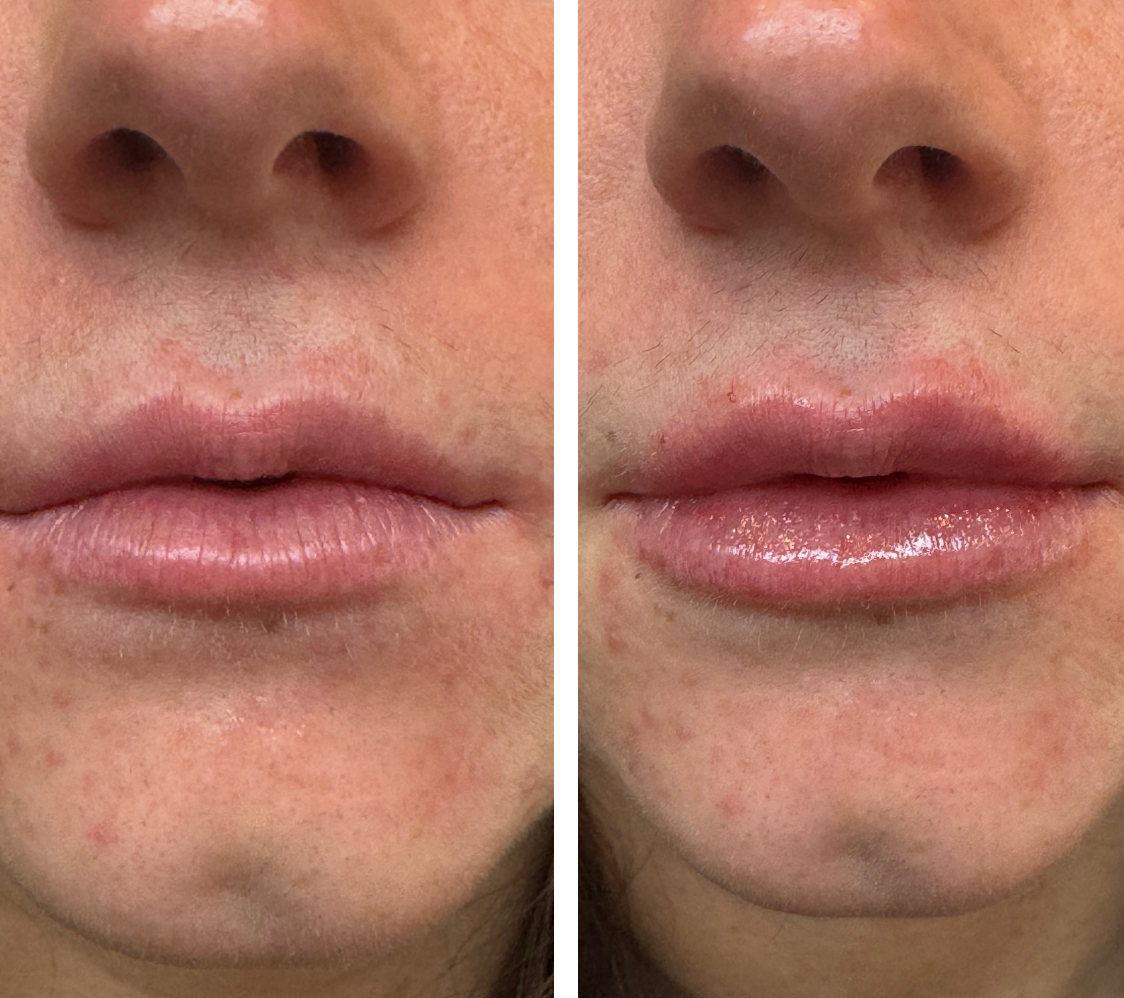 Before and After Image: Lips – Kysse - front