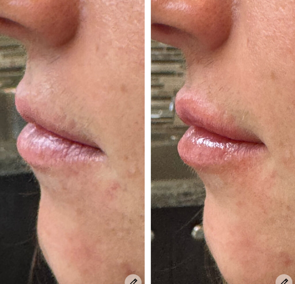 Before and After Image: Lips – Kysse - left-side