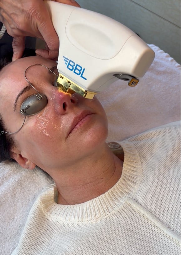 BBL Skin in West Des Moines, IA