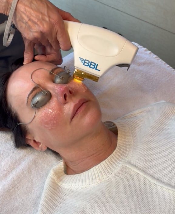 BBL Skin in West Des Moines, IA